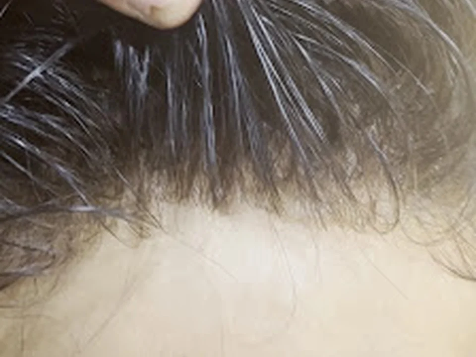 HAIR SOLUTIONS & HAIR PATCH (adrash)