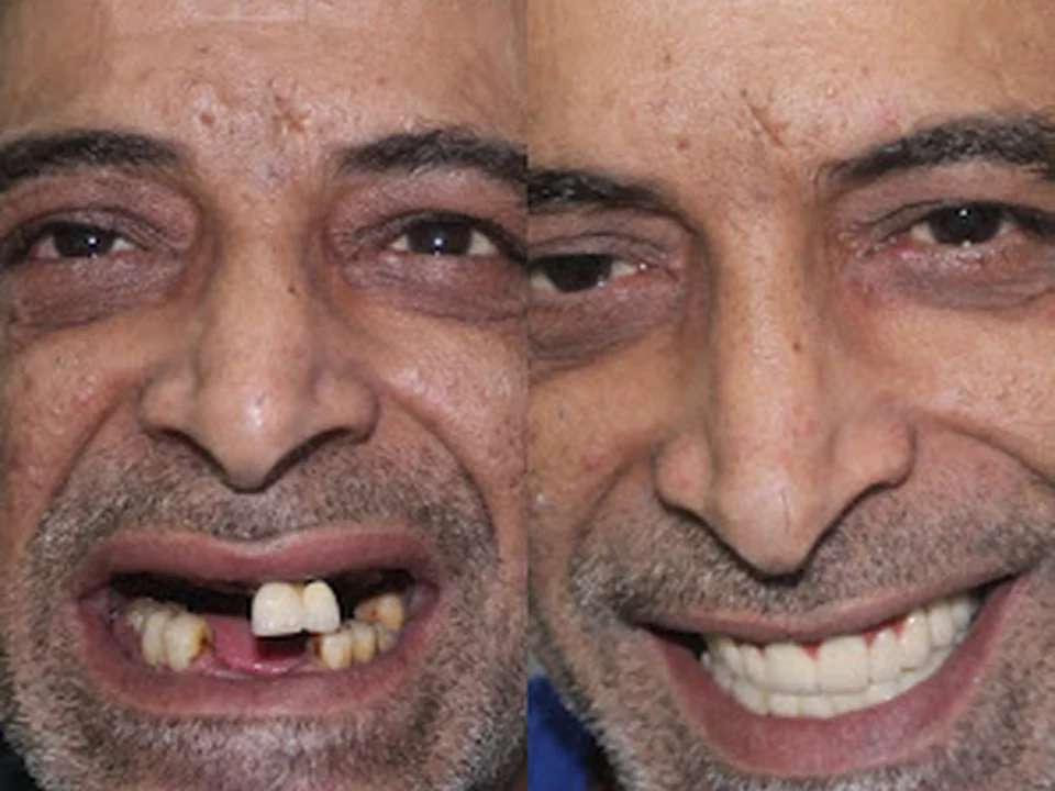 Toothastu Dental Clinic | Dental Implants, Braces, Root Canal Treatment, in Colaba, Mumbai