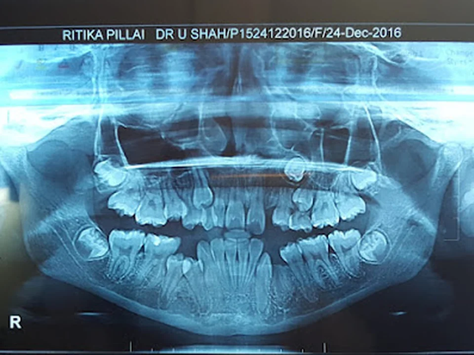 Wisdom tooth surgery